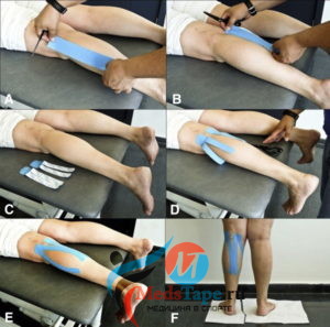 Пошаговая инструкция по тейпированию коленного сустава при артрозе