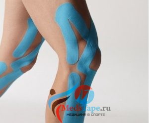 Тейпирование колена при травме мениска