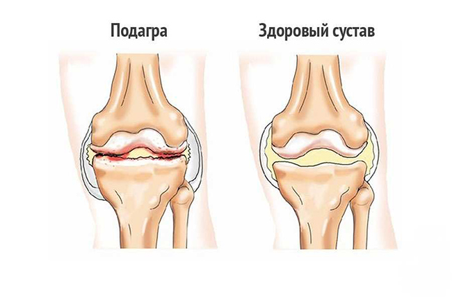 Изменение коленного сустава при подагре