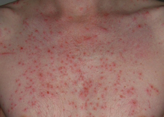 Аллергия на пот на груди