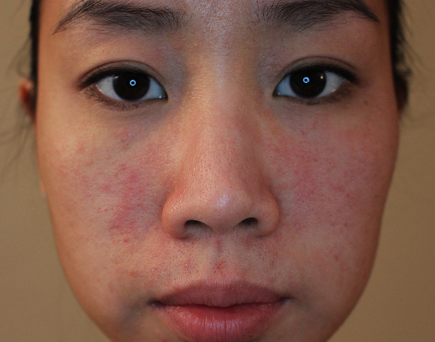 Аллергия на пот на лице