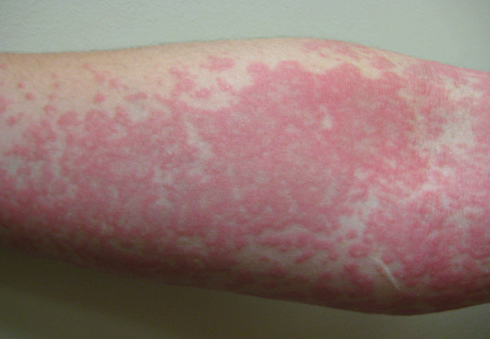 Сильная аллергия на руке