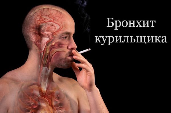 Возникновение бронхита у курильщиков