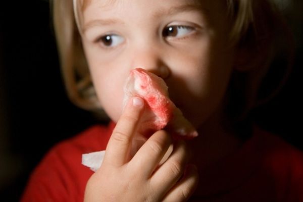 Носовое кровотечение у ребенка