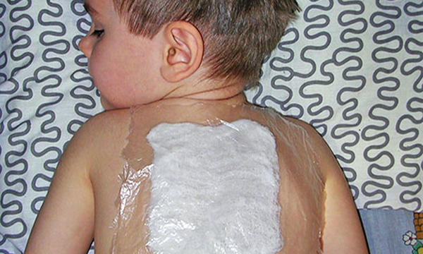 Компресс на спине ребенка при кашле