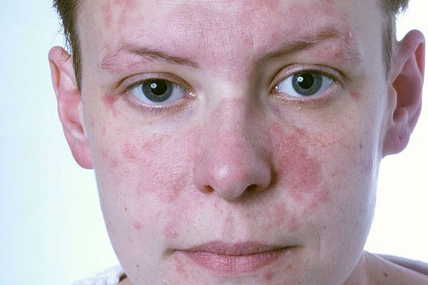 Аллергия на лице от курения