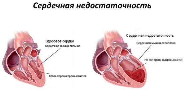 Изменения сердца при сердечной недостаточности