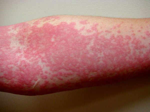 Аллергия на руке от прививки