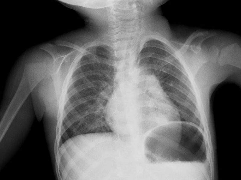 Рентгенография при воспалении легких