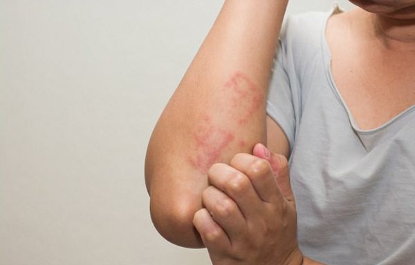 Аллергическая реакция на коже руки
