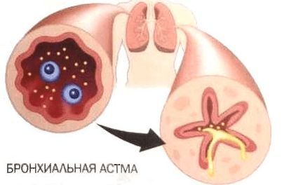 Бронхи при бронхиальной астме