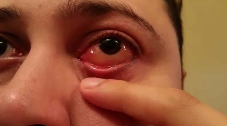 Проявление аллергии на глазах