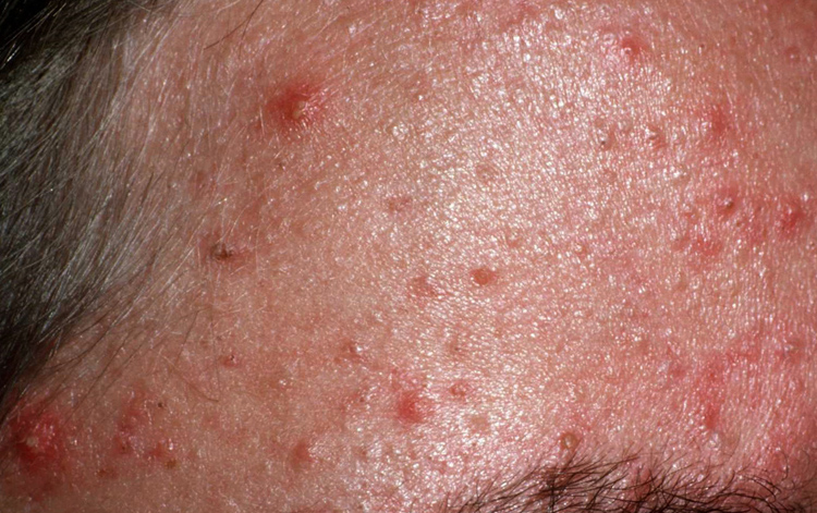 Контактный аллергический дерматит на лице фото