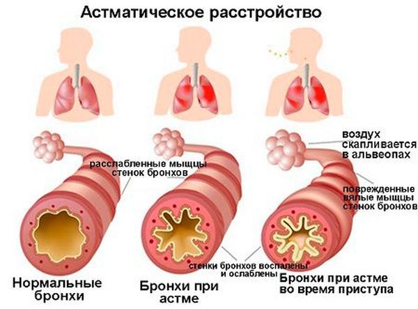 Бронхи человека в норме и при астме