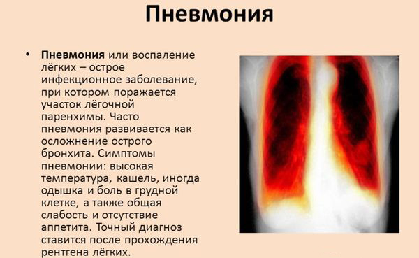 Пневмония - описание заболевания