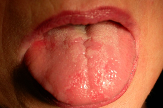 Проявление аллергии на языке
