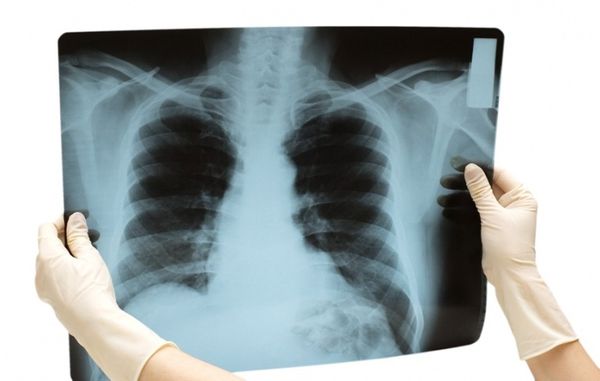 Рентгенологический снимок легких у больного человека